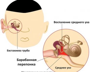 Средний отит уха: симптомы и лечение всех разновидностей