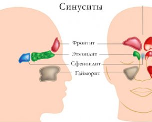 Симптомы хронического синусита, схема лечения заболевания